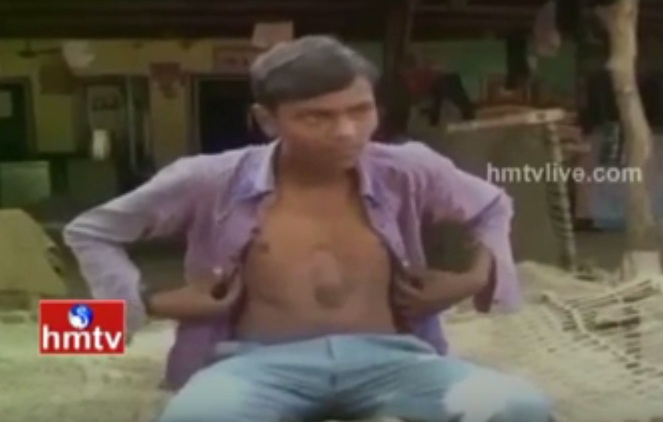 #تيوب_المواطن : شاب هندي ينبض قلبه خارج جسمه