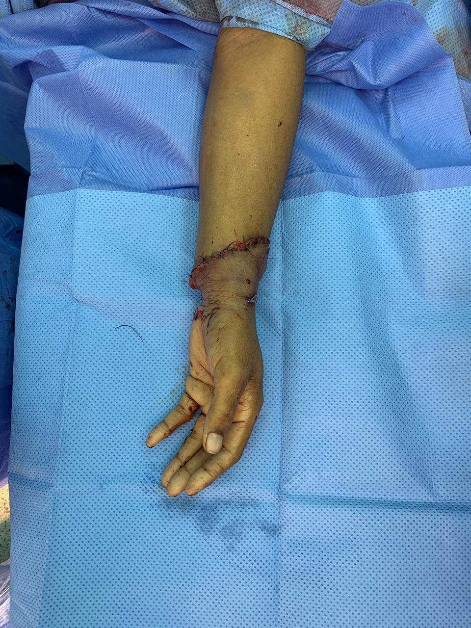 جراحة الـ 12 ساعة تعيد يد مقيم مبتورة في ‏سعود الطبية