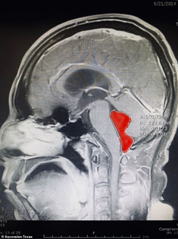 دودة شريطية تستقر في دماغ رجل