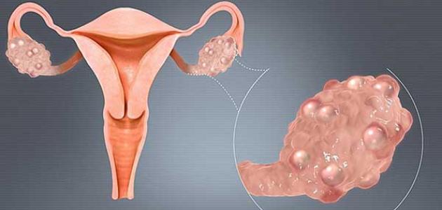 كيف يتم علاج تكيس المبايض