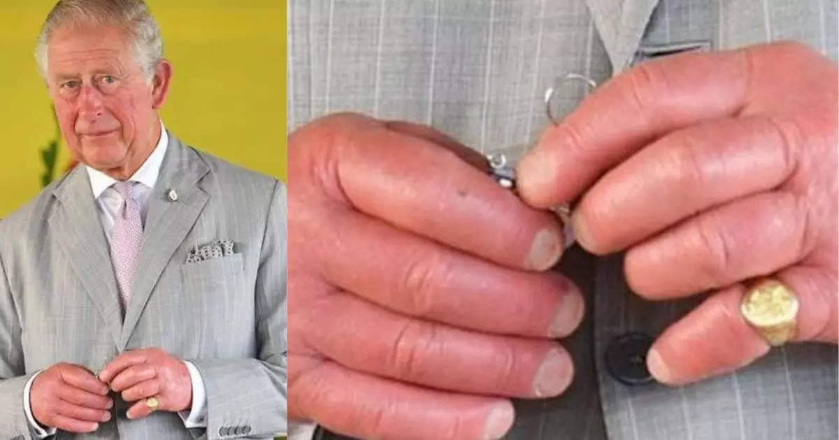 Doctor reveals the secret of swollen fingers of King Charles - time ...