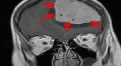 مستشفى الملك سلمان ينقذ سيدة من ورم في الدماغ