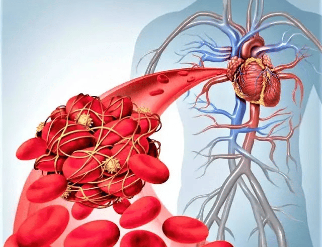 من أقل الناس إصابة بالجلطات؟