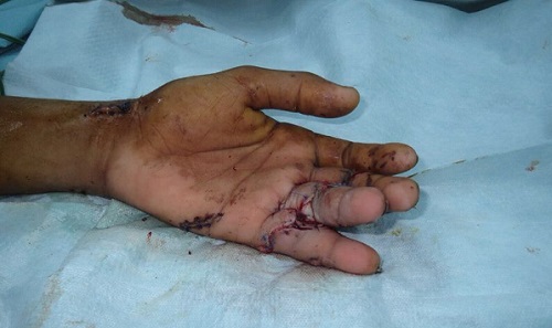 إعادة “أصابع” يد متهتكة لمريض بمستشفى الملك فهد بجازان