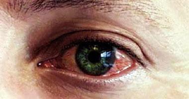 تعرّف على أسباب النزيف داخل العين