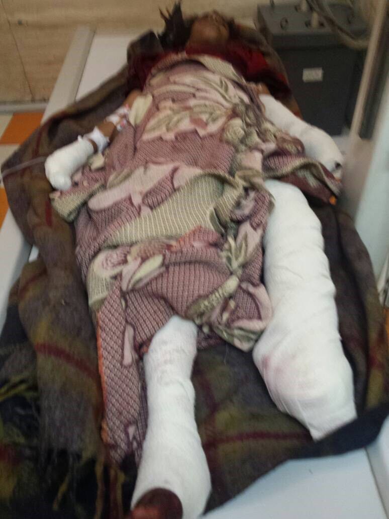 لغم الحوثي يبتر ساق طفلة ويصيب أخرى في جانبها الأيمن